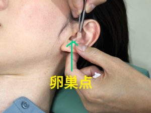 PMSに耳つぼの卵巣点