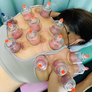 大阪市阿倍野区Ｔさんカッピング吸玉施術のホットペッパー口コミ書いていただきました。